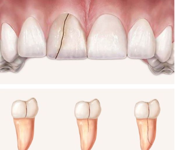 Răng bị nứt: Nguyên nhân và giải pháp khắc phục