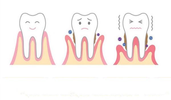 Răng bị lung lay: Nguyên nhân và cách khắc phục như thế nào?