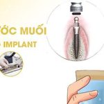 Top 6 đối tượng nào không nên trồng răng implant