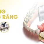 Top 7 biến chứng sau khi thực hiện cấy ghép implant