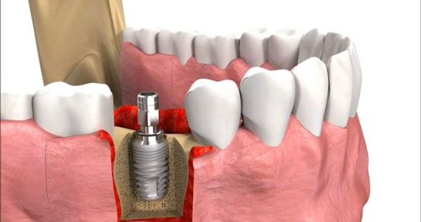 Nguyên nhân trụ implant bị đào thải