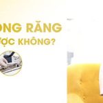 Top 5 yếu tố ảnh hưởng đến tuổi thọ răng implant