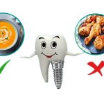 Hình ảnh trồng răng implant tại Drngocimplant