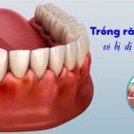 Trụ Implant Anthogyr: Xuất xứ, cấu tạo và ưu điểm nổi bật