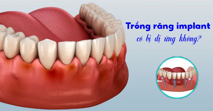 Giải đáp: Trồng răng implant có bị dị ứng không?