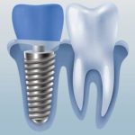 Các dòng trụ implant Đức phổ biến nhất thị trường hiện nay