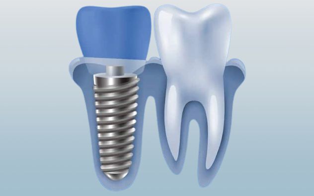 Trụ Implant Alphadent