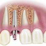 Trụ implant adin: Xuất xứ, cấu tạo và ưu điểm nổi bật