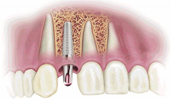 Top 5 nguyên nhân trụ implant bị đào thải