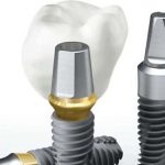 Nguồn gốc xuất xứ và cấu tạo của trụ Implant Biotem