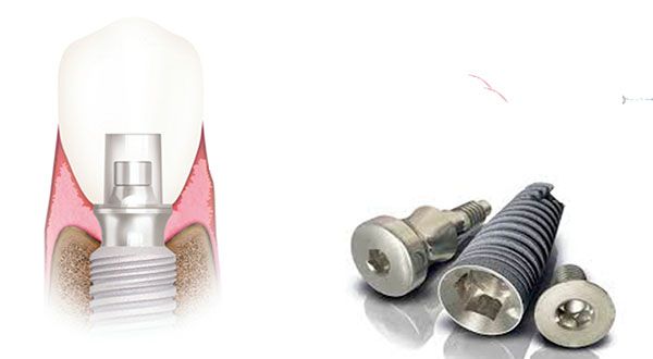 Trụ Implant Paltop: Xuất xứ, cấu tạo và ưu điểm nổi bật