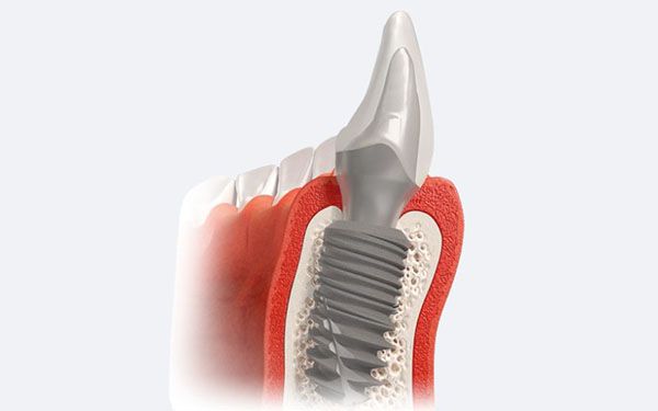 Tại sao trụ Implant Tekka Pháp được sử dụng rộng rãi