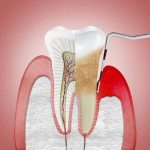 Trám răng rồi nhưng vẫn đau: Nguyên nhân và cách khắc phục