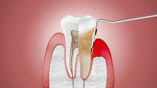 Viêm nha chu cấy ghép implant được không?