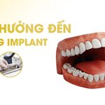 Trẻ em độ tuổi mới lớn trồng răng implant được không?