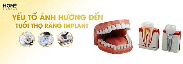 Top 5 yếu tố ảnh hưởng đến tuổi thọ răng implant