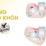 Biểu hiện việc trồng răng implant thất bại chắc chắn cần biết