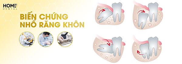 Biến chứng nhổ răng khôn: Biểu hiệu và cách khắc phục