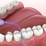 Bọc răng sứ ceramill Zolid: Cấu tạo và ưu điểm nổi bật