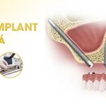 Ghép xương cấy implant có đau không chắc chắn phải biết