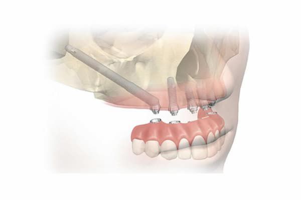 Cấy ghép implant xương gò má là gì?