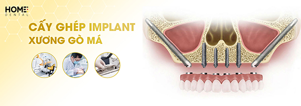 Cấy ghép implant xương gò má là gì? Ưu điểm nổi bật như thế nào?