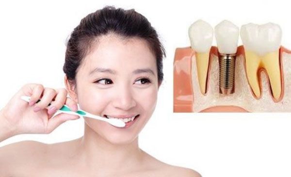 trồng răng implant có bị hôi miệng không do quá trình chăm sóc