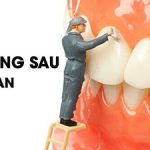 Top 5 kinh nghiệm đi trồng răng implant phải biết