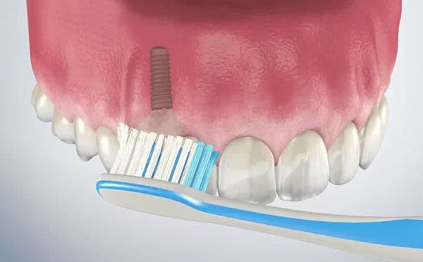 Chăm sóc răng sau khi trồng răng implant