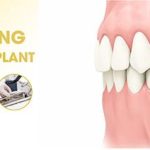 Ghép xương trong cấy ghép implant là gì? Trường hợp nào nên ghép xương