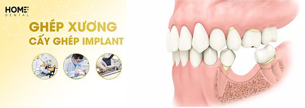 Ghép xương cấy implant