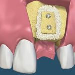 Ghép xương cấy implant có đau không chắc chắn phải biết