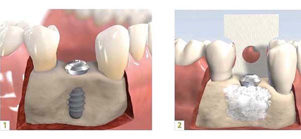 ghép xương trong cấy ghép implant 