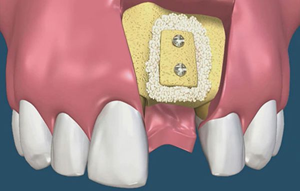 Ghép xương trong cấy ghép implant là gì? Trường hợp nào nên ghép xương