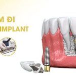 Tác dụng phụ của trồng răng implant như thế nào?