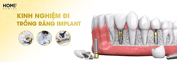 Kinh nghiệm đi trồng răng implant