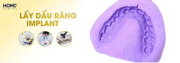 Lấy dấu răng implant