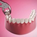 Trồng răng implant bị sưng: Nguyên nhân và biện pháp khắc phục