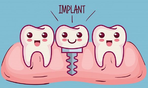 Những trường hợp nên trồng răng implant