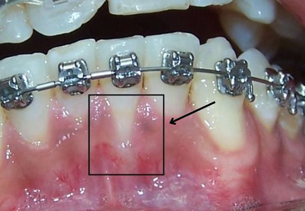 Niềng răng bị tụt lợi