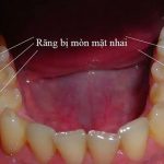 Niềng răng tháo lắp trẻ em có ưu điểm gì nổi bật?