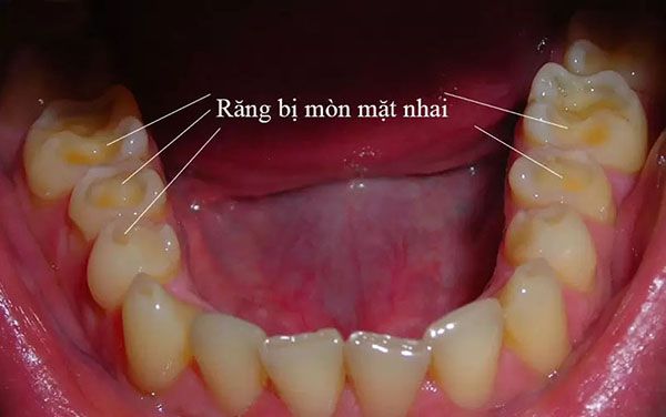 Tổng quan những điều cần biết răng bị mòn mặt nhai