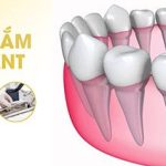 Trụ implant yes biotech: Xuất xứ, cấu tạo và ưu điểm nổi bật