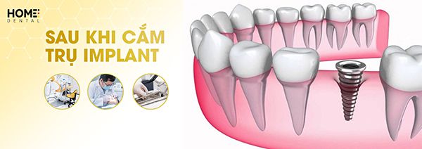 Sau khi cắm trụ implant