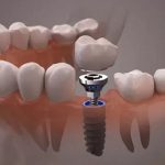 Top 5 kinh nghiệm đi trồng răng implant phải biết