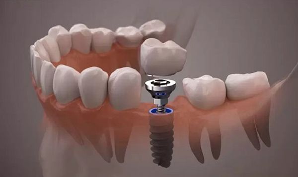 Tác dụng phụ của trồng răng implant như thế nào?