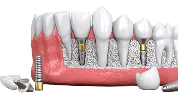 Kinh nghiệm đi trồng răng implant là tìm hiểu trước trồng răng implant