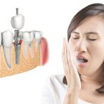 Trồng răng implant bị sưng: Nguyên nhân và biện pháp khắc phục