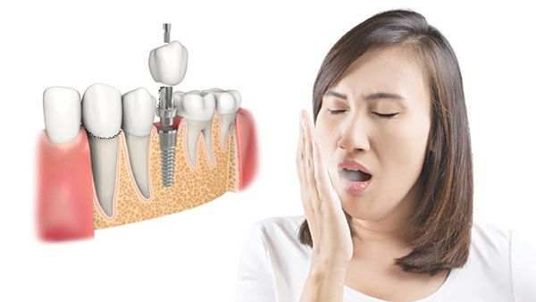 Trồng răng implant có bị hôi miệng