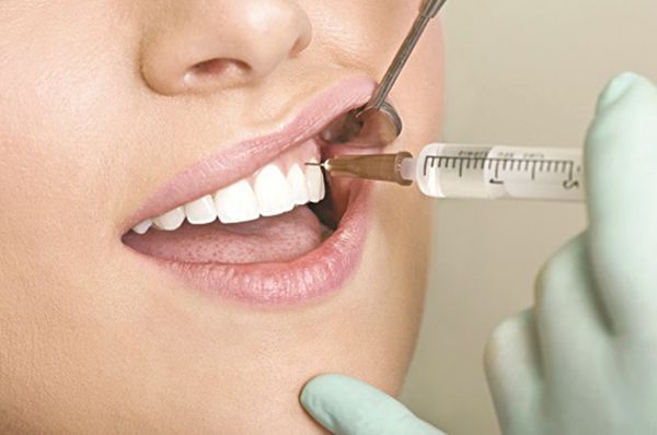 Trồng răng implant nên gây tê hay gây mê